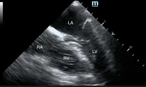POCUS Heart Apical 4-Chamber