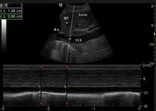 POCUS IVC Respiratory M-mode